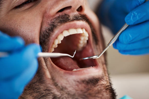 Best Broken or Chipped Tooth Repair in Lake Lorraine, FL