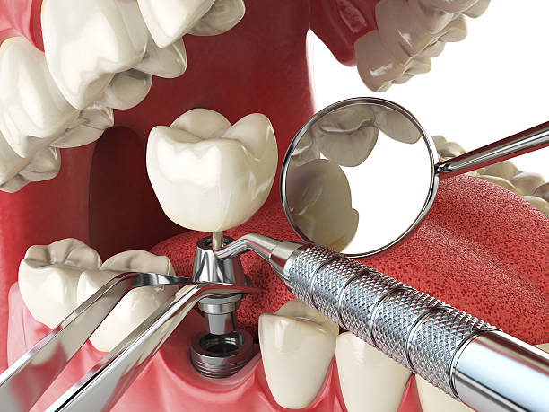 Best Emergency Dental Care for Sports Injuries in Lake Lorraine, FL